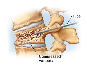 Side view of compressed vertebra and disks. Tube goes through back of vertebra into vertebral body.