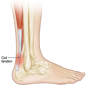 Side view of foot and ankle showing cut Achilles tendon.